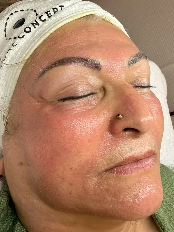 Gesicht derselben Kundin mit rosiger, frischer Haut nach dem Microneedling