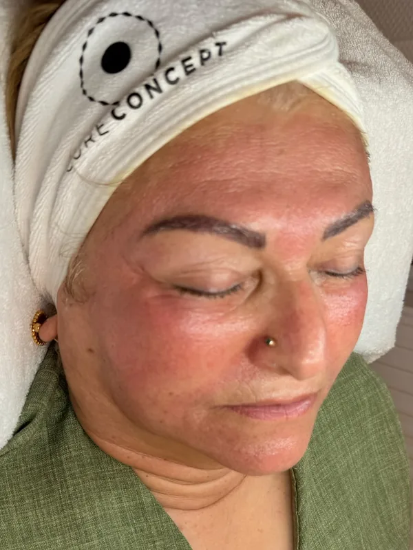 Gesicht einer Kundin vor dem Microneedling